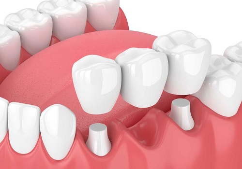 Phục hình răng sứ chính xác và dễ hiểu nhất