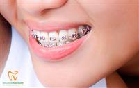 Tại sao lựa chọn công nghệ niềng răng Invisalign để chỉnh nha?